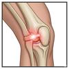 osgood schlatter