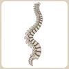 scoliose